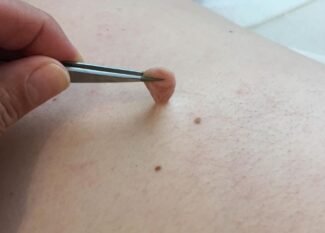 Remove Skin Tags in One Night