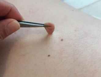 Remove Skin Tags in One Night
