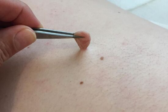 Remove Skin Tags in One Night