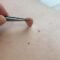 Remove Skin Tags in One Night