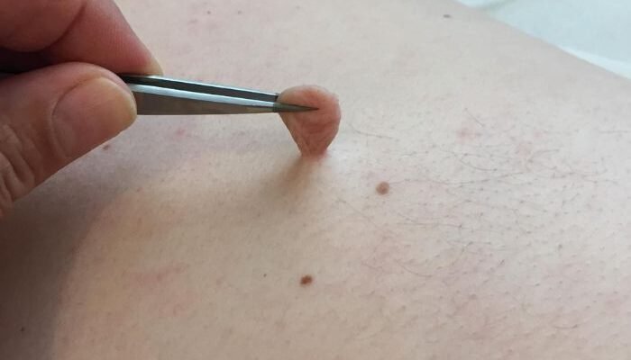 Remove Skin Tags in One Night