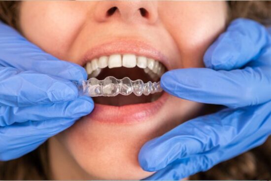 Clear Aligners
