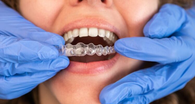 Clear Aligners