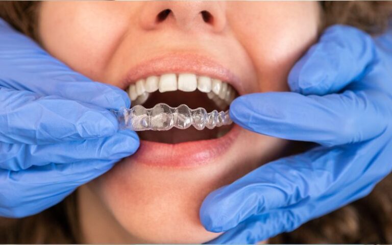 Clear Aligners