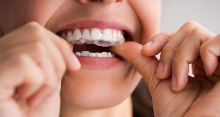 Clear aligners safety