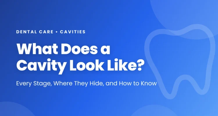 What does a cavity look like: from chalky white spot to brown spot to hole, where cavities hide between teeth and in molar grooves, cavity vs stain, and prevention